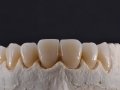 Stillo-aplicacao-ceramica-caso-2